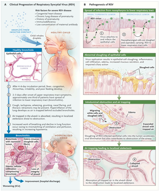Da: Viral Bronchiolitis in Children | NEJM.